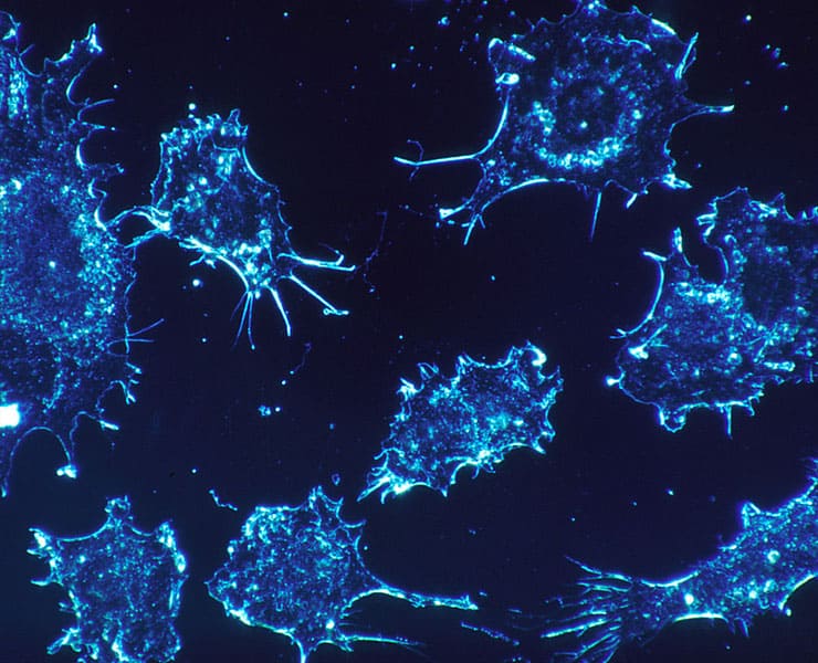 خلايا سرطانية, الذكاء الاصطناعي, تقنية, علاج السرطان