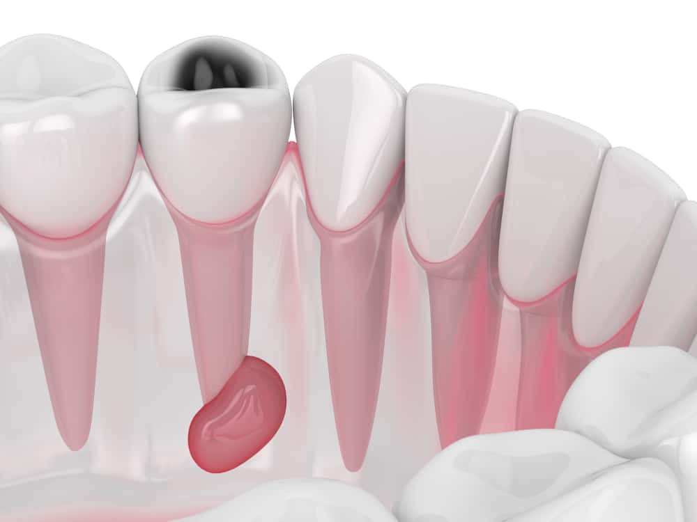 يسبب تلوث الدم خر اج الأسنان وعلاجه بوبيولار ساينس العلوم للعموم