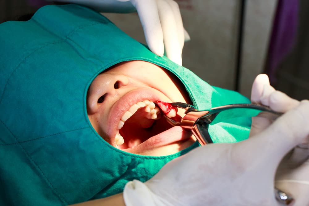علاج خراج الأسنان