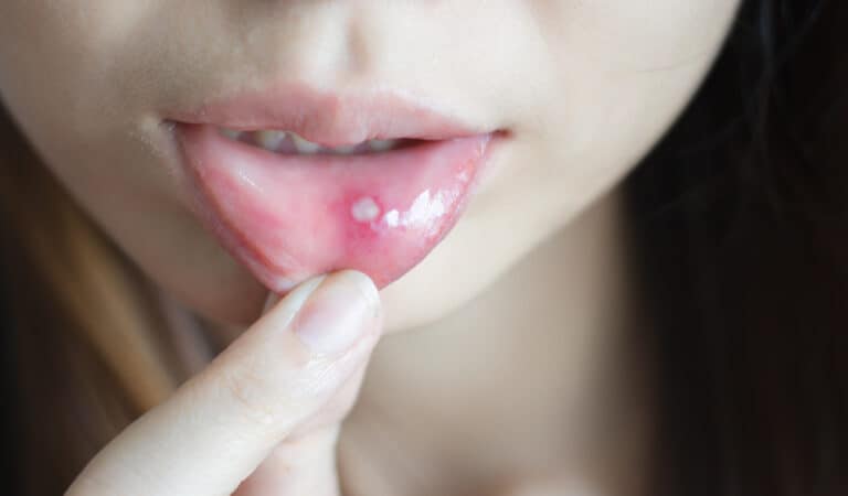 فطريات الفم