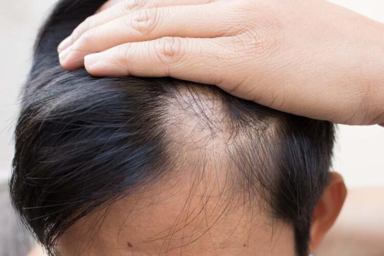 علاج جديد موافق عليه من قبل إدارة الغذاء والدواء لتساقط الشعر لدى مرضى الثعلبة