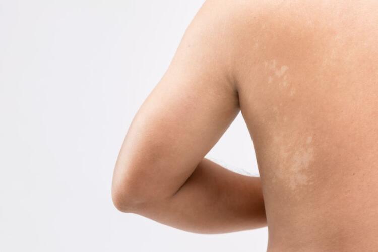 ما هو سبب ظهور البقع البنية في الجلد «الفطريات» وما علاجها؟