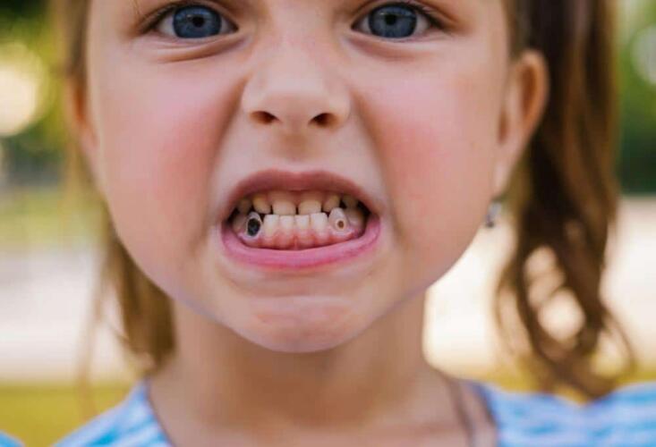 هل يمكن علاج الأسنان المتآكلة عند الأطفال؟
