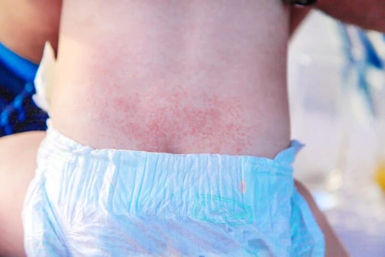 أسباب تسلخات الجلد عند الأطفال وطريقة علاجها