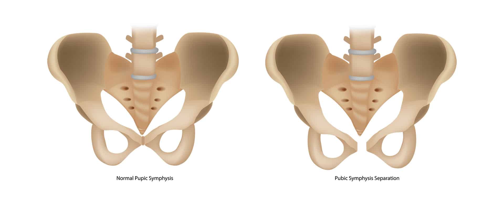 التهاب أغشية وأوتار وعظام الحوض Osteitis Pubis