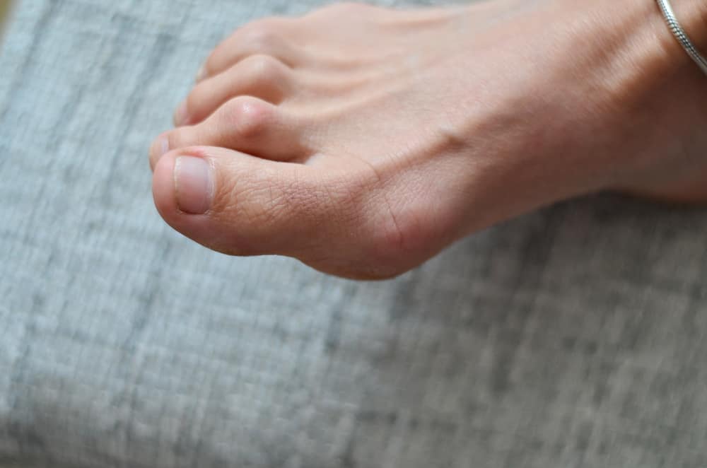 إصبع القدم ذو شكل المخلب أو المطرقة (Hammertoe)