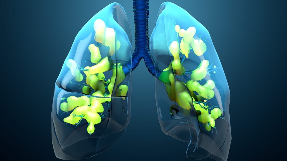 متلازمة الضائقة التنفسية الحادة