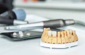 حتى تختار الأنسب لأسنانك: تعرّف إلى الفرق بين الفينير واللومينير
