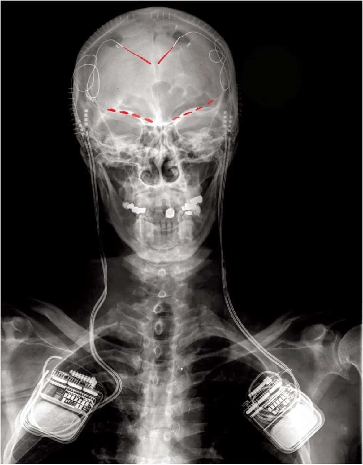 (هذه العلامات هي درجات شدّة الألم) صورة أمامية بالأشعة السينية لأحد المشاركين في الدراسة، تُظهر الأقطاب المزروعة لتسجيل النشاط الدماغي (البقع باللون الأحمر) المتصلة بأجهزة تحفيز الدماغ وتسجيل نشاطه ثنائية الاتجاه المزروعة على كلا الجانبين. براساد شيرفالكار