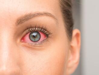 ما أسباب حرقة العين وكيف يمكن علاجها؟