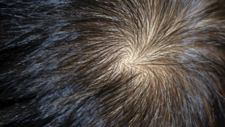 تعرف إلى تأثير العوامل الوراثية في تشكيل دوامات الشعر