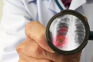 ما هي متلازمة الشرق الأوسط «التنفسية»؟ وكيف تتعامل مع المصاب بها؟