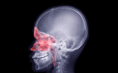 ما هي أعراض سرطان الجيوب الأنفية؟